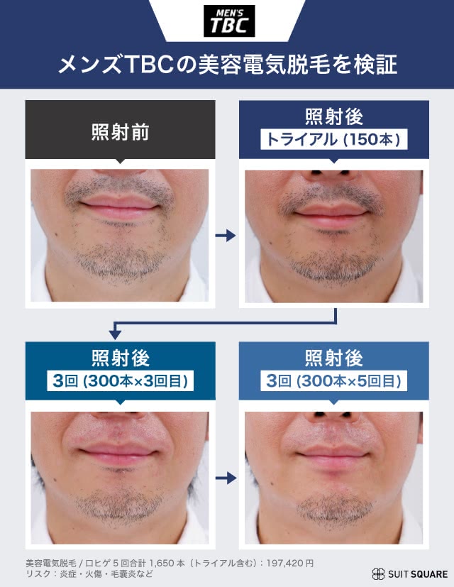 メンズYBCの脱毛効果を編集部員が実際に受けて検証