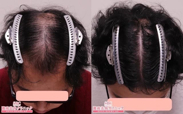 湘南美容クリニックのAGA治療効果