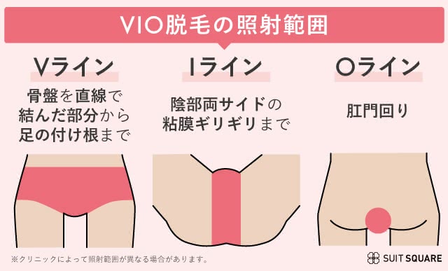 VIO脱毛の照射範囲