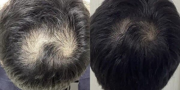 Dr.AGAクリニックのAGA治療効果