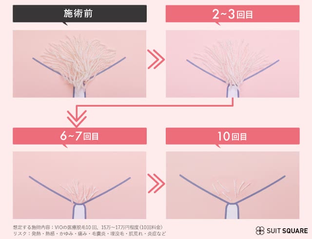 医療脱毛の経過イメージ