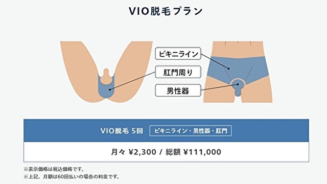 VIO脱毛5回プラン