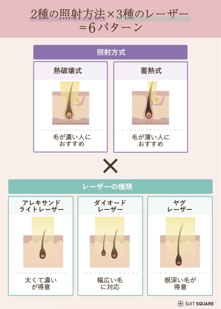 脱毛機の種類