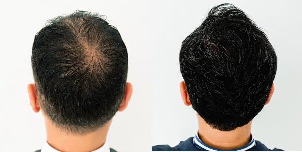 イースト駅前クリニックのAGA治療効果