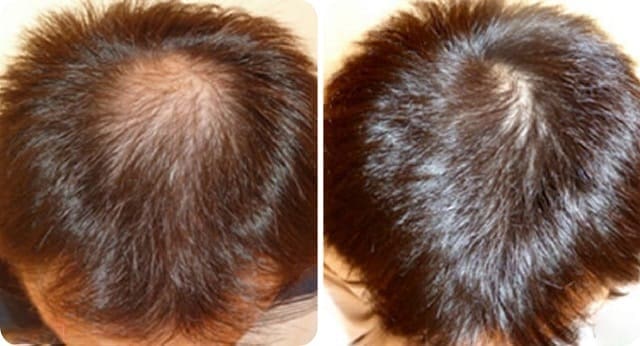 ゴリラクリニックのAGA治療効果