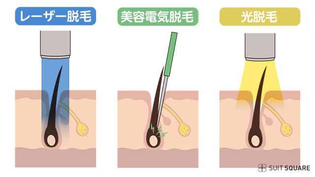 3つの脱毛方法