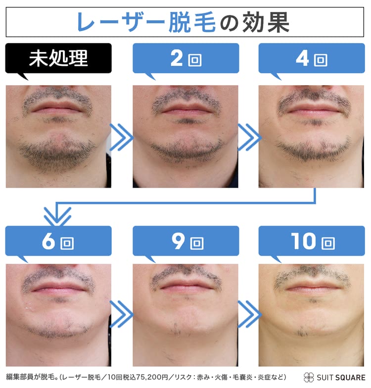 編集部員が実際に医療脱毛を受けてヒゲの状態や効果を徹底検証