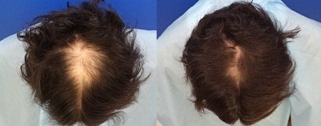 DクリニックのAGA治療効果