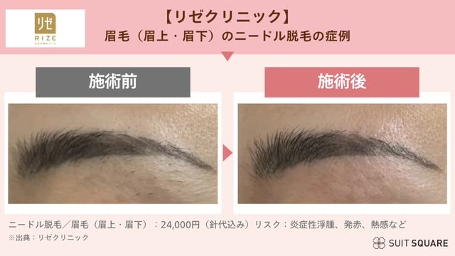 リゼクリニックの症例画像