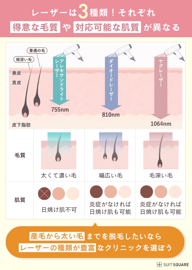 医療脱毛クリニックの選び方②レーザー