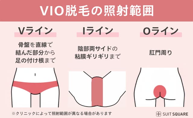 VIO脱毛の照射範囲