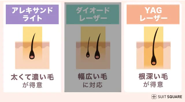 レーザー3種類の比較