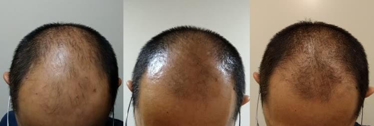 クリニックフォアのAGA治療効果