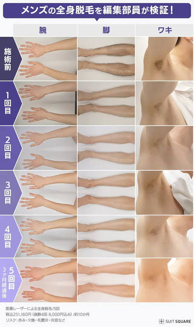 編集部員がメンズ全身脱毛5回通った効果検証画像