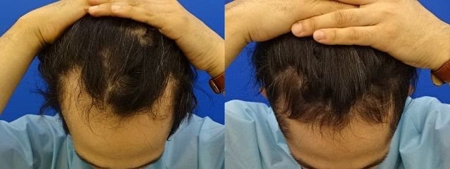 DクリニックのAGA治療効果