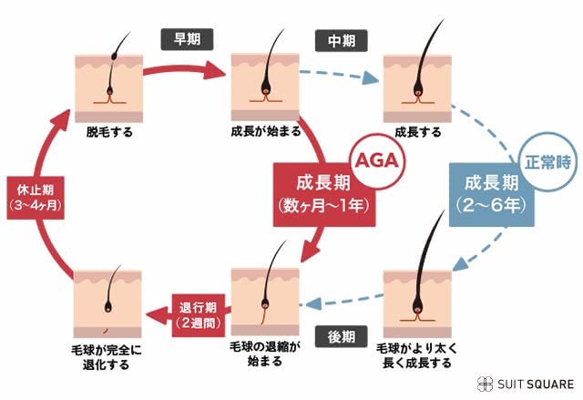 AGAを発症する仕組みの画像