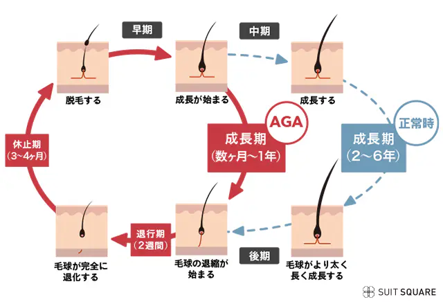 AGAを発症する仕組みのイラスト