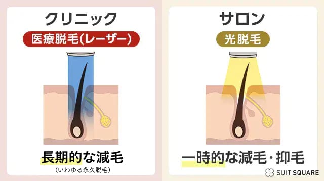 クリニックは永久脱毛、サロンは減耗や抑毛ができるイラスト