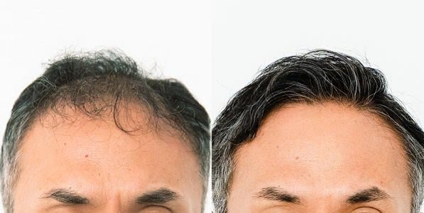 イースト駅前クリニックのAGA治療効果