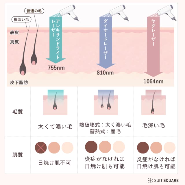 レーザーの違い