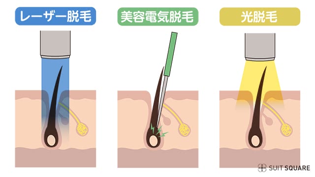 脱毛の種類を説明する画像