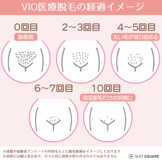 VIO脱毛の経過