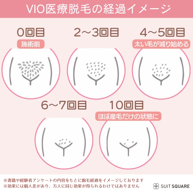 VIO医療脱毛の経過