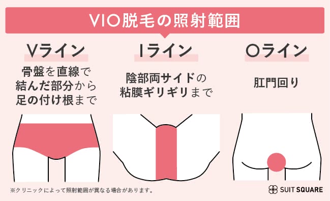 VIO脱毛の照射範囲